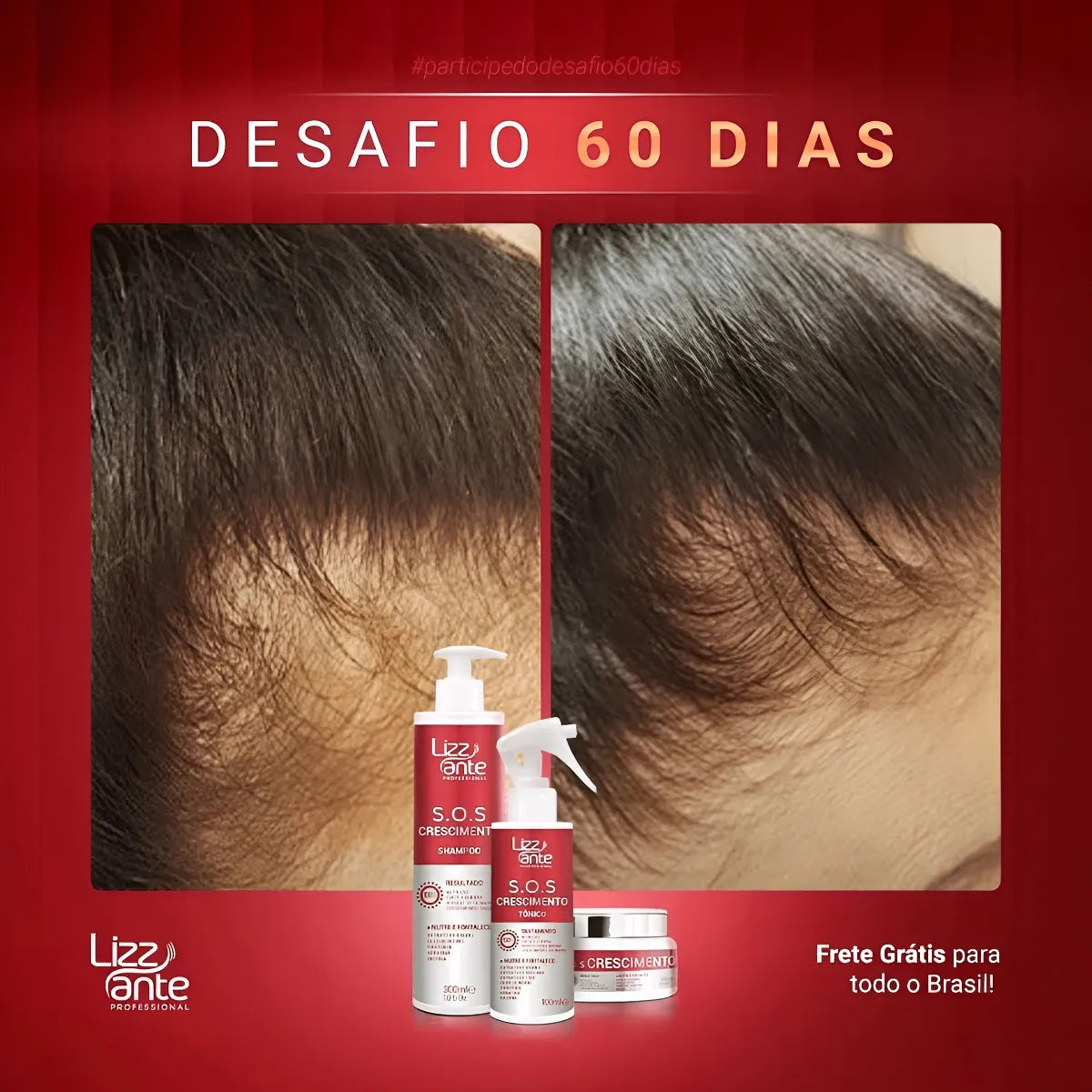 Sos Crescimento Rápido Combate Queda Calvície Falha Alopecia