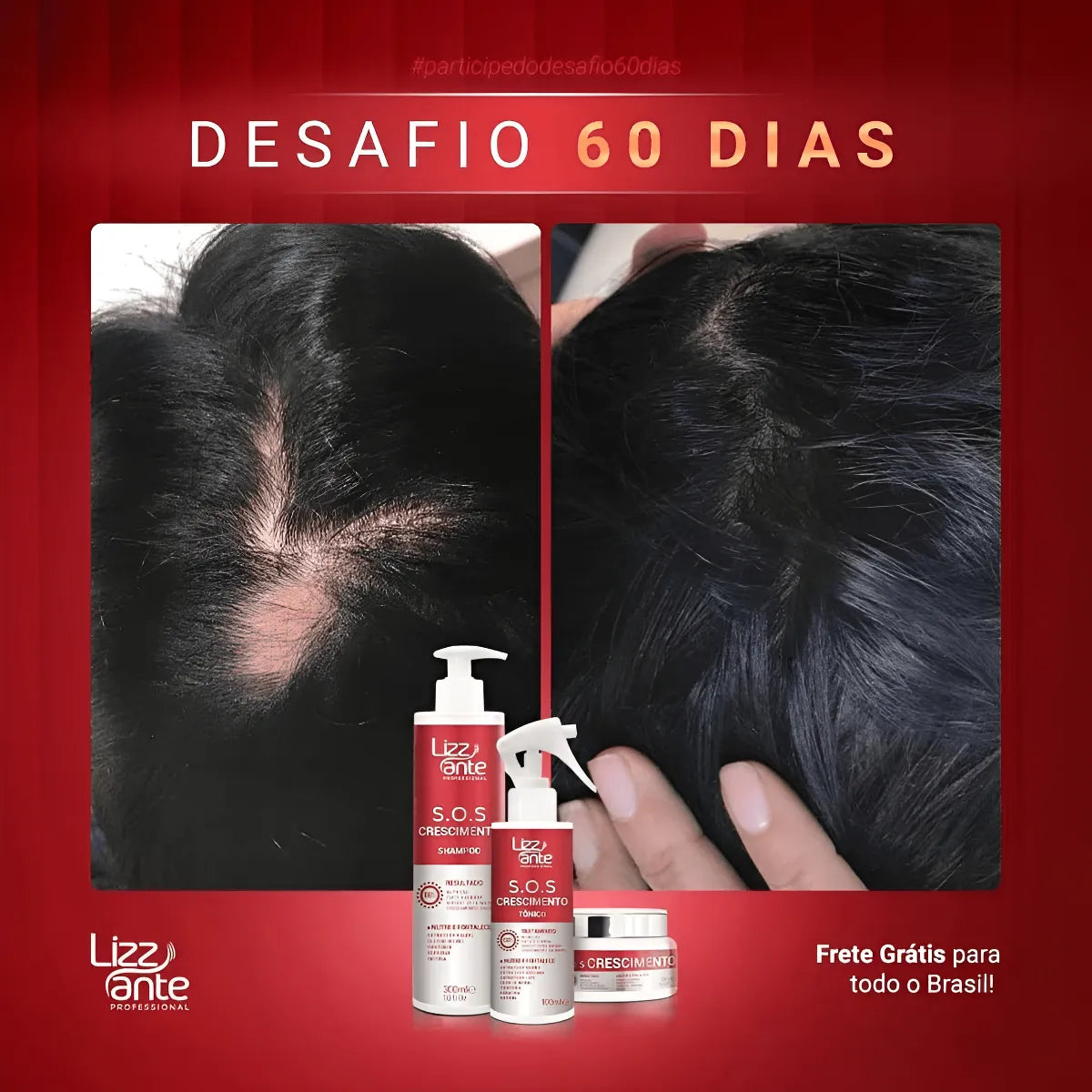 Sos Crescimento Rápido Combate Queda Calvície Falha Alopecia